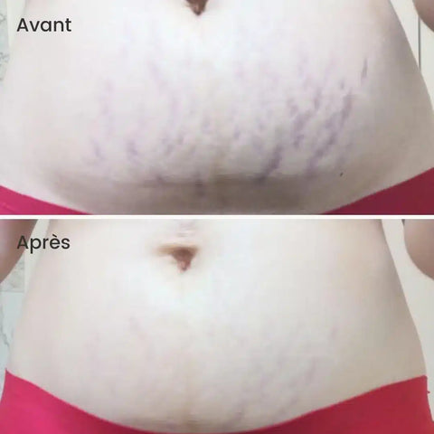 Baume SOS Vergetures 100 ml Laboratoires Téane - Blossom Care